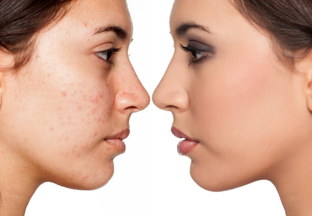 Comparison portrait of a woman with problematic skin without and with makeup